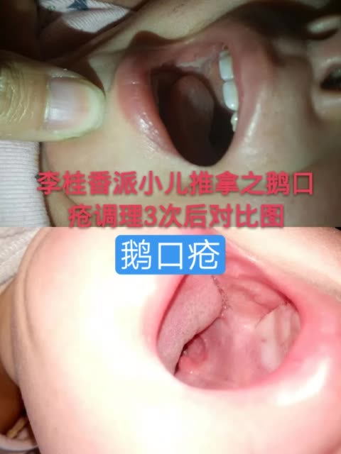 鹅口疮家长看看自己的孩子有没有    