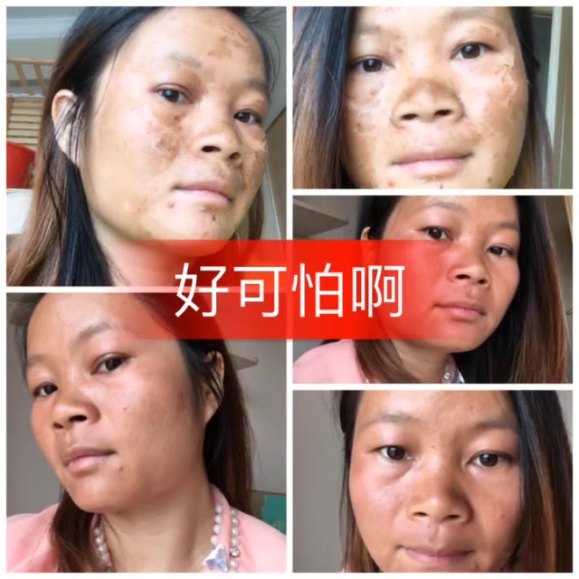 做了脸以后脸上的毒素黑色素全都排出来,斑和痘印几乎没有了,大家一起