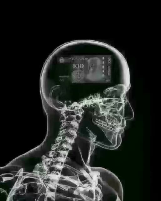 最近老爱头疼,今天去医院检查照了个ct,医生说没啥问题以后少想一点