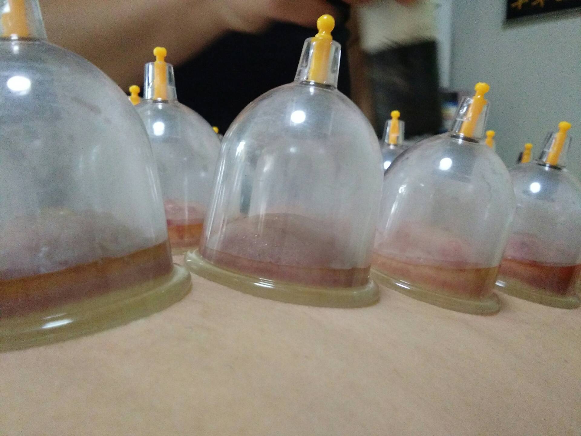 这是我今天本人做的背部群罐排毒,排的全是湿毒―黄水 2年前