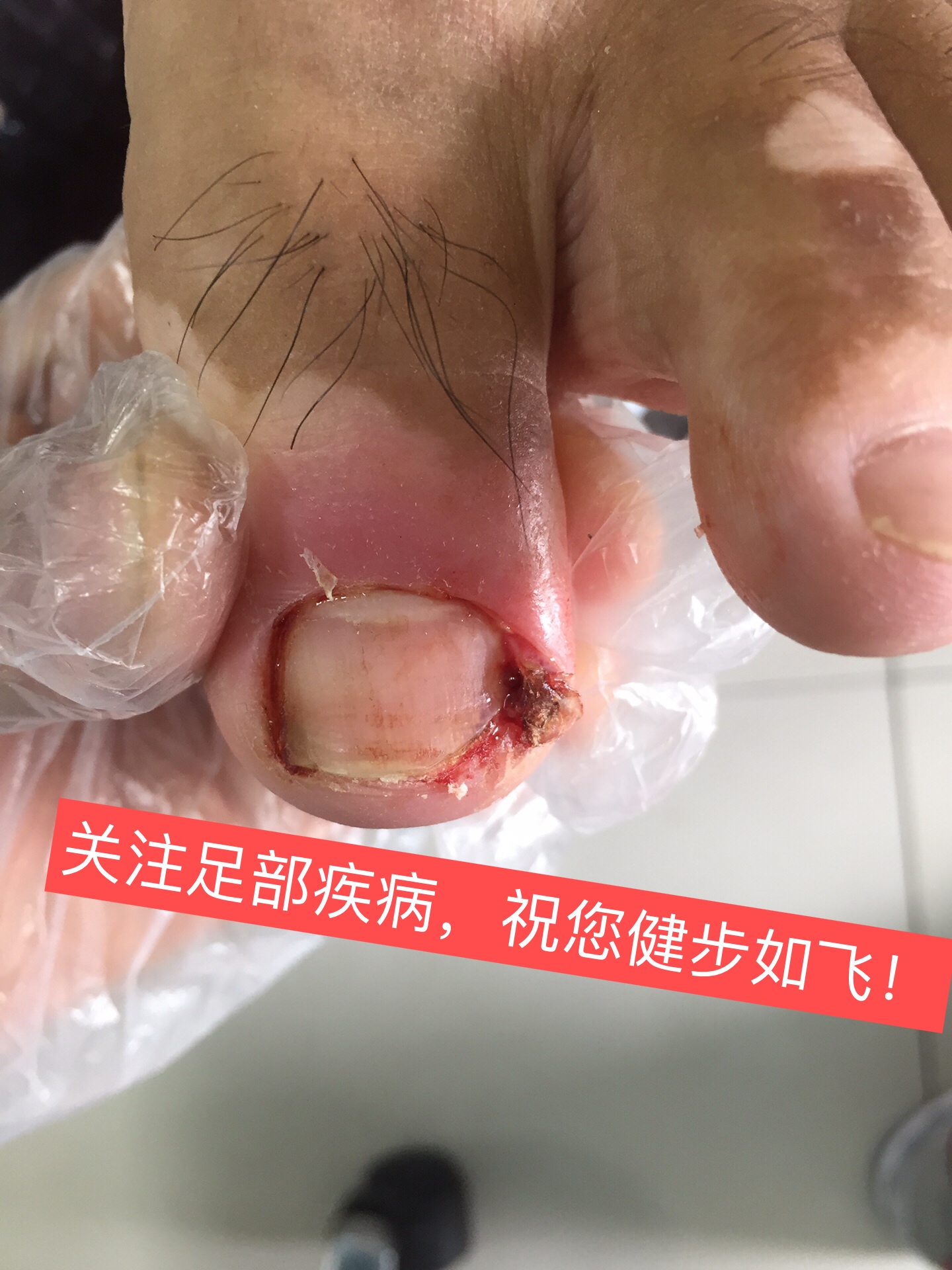 刘一刀修脚!还您足部健康!