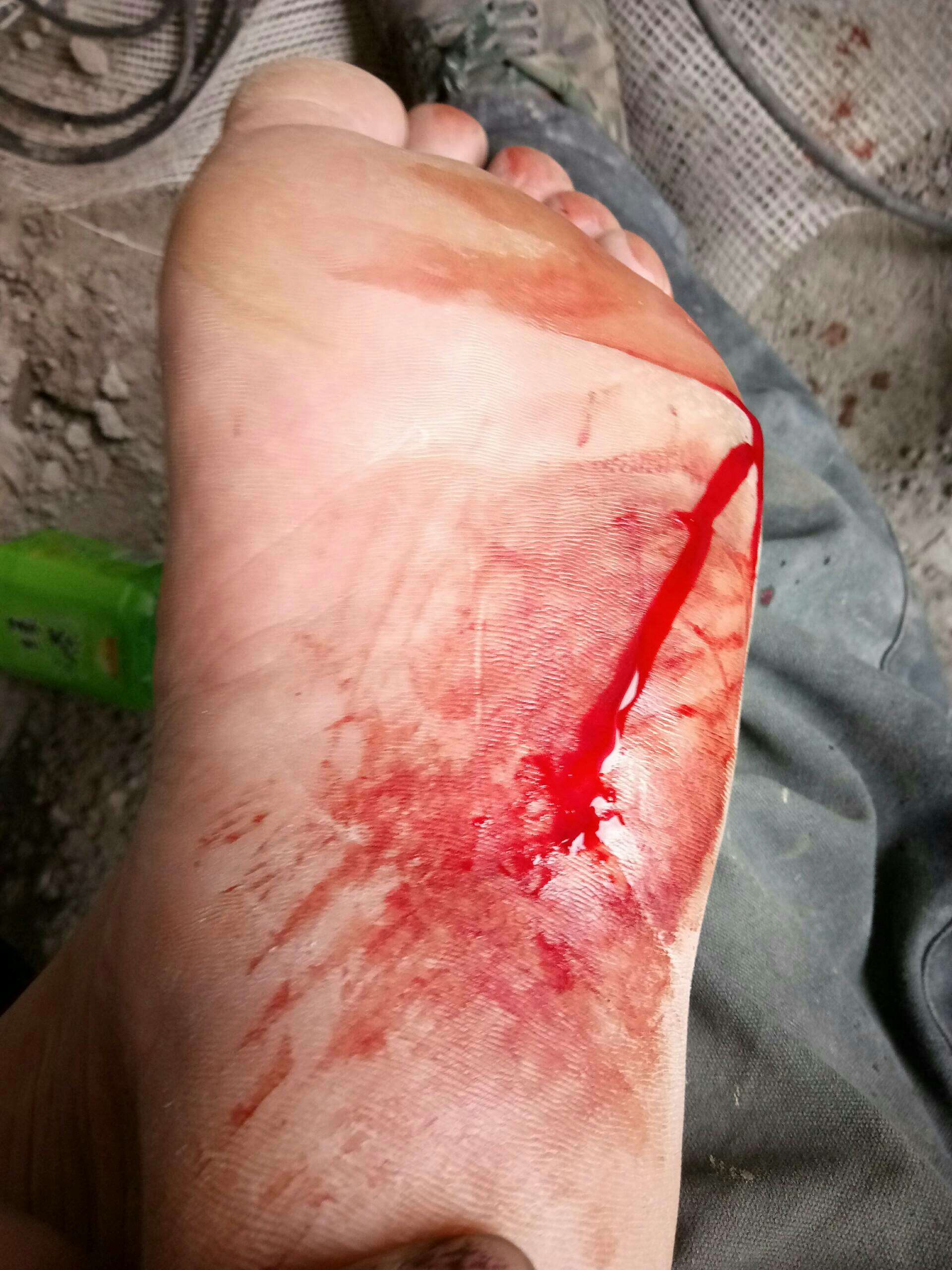 脚底玻璃扎伤流血图片图片