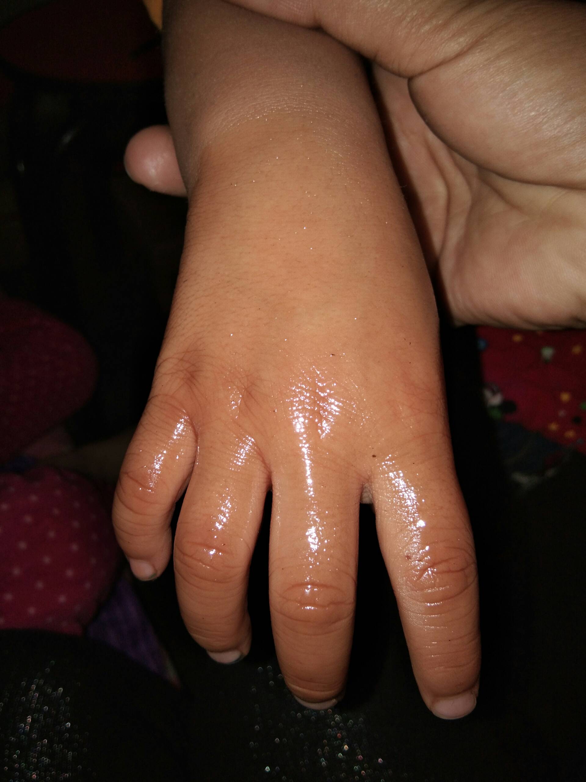 宝宝手烫了 2年前