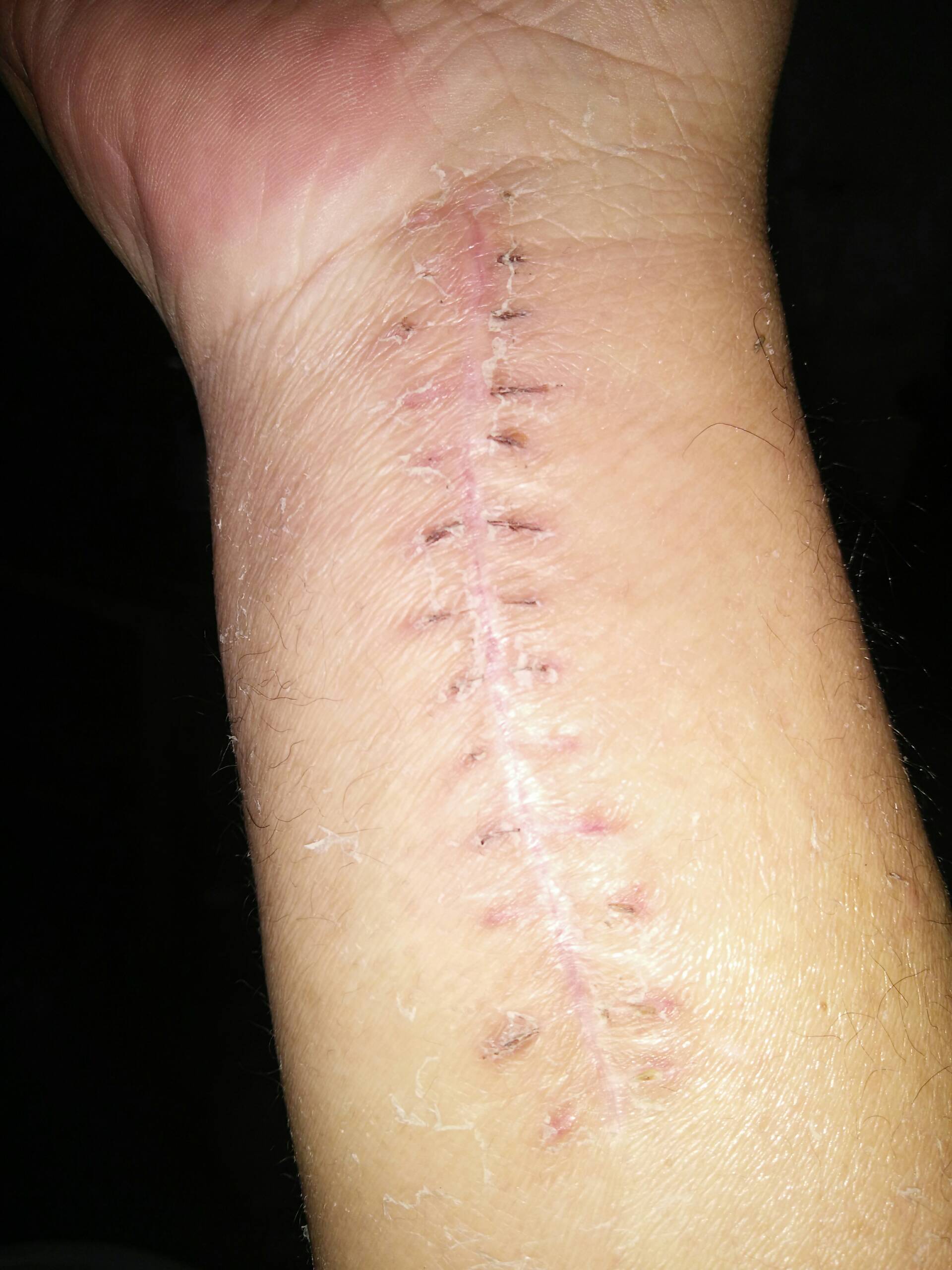 刀口已经长好  为什么手腕还不能弯曲呢 236       赞