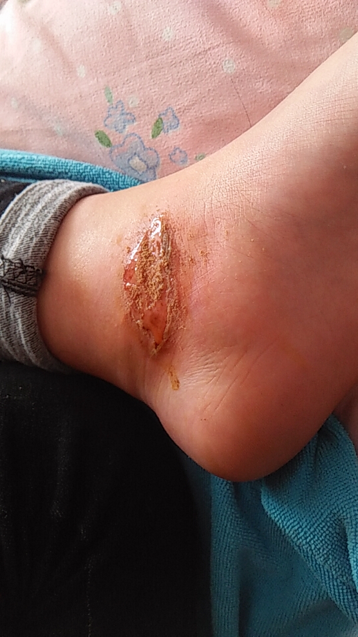 开了一个脚眼,,, 2年前