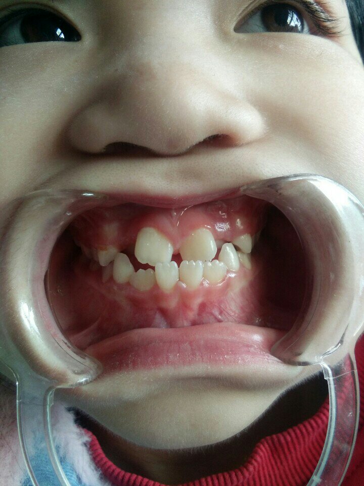 九岁反颌活动矫治 9月前