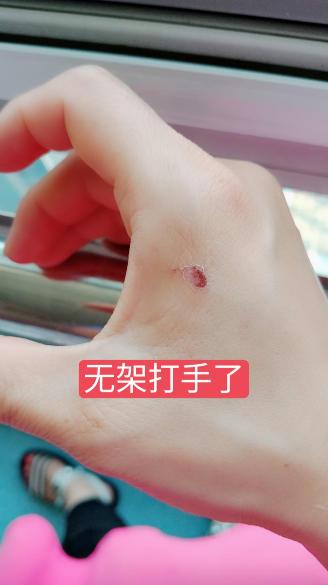 玩了这么久的无架第一次失手把自己打成这样 2138     44 赞