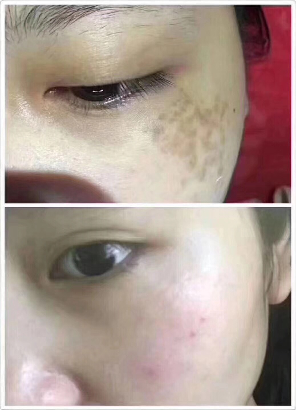 下图就是真皮斑,斑中之癌  为什么真皮斑如此难治?