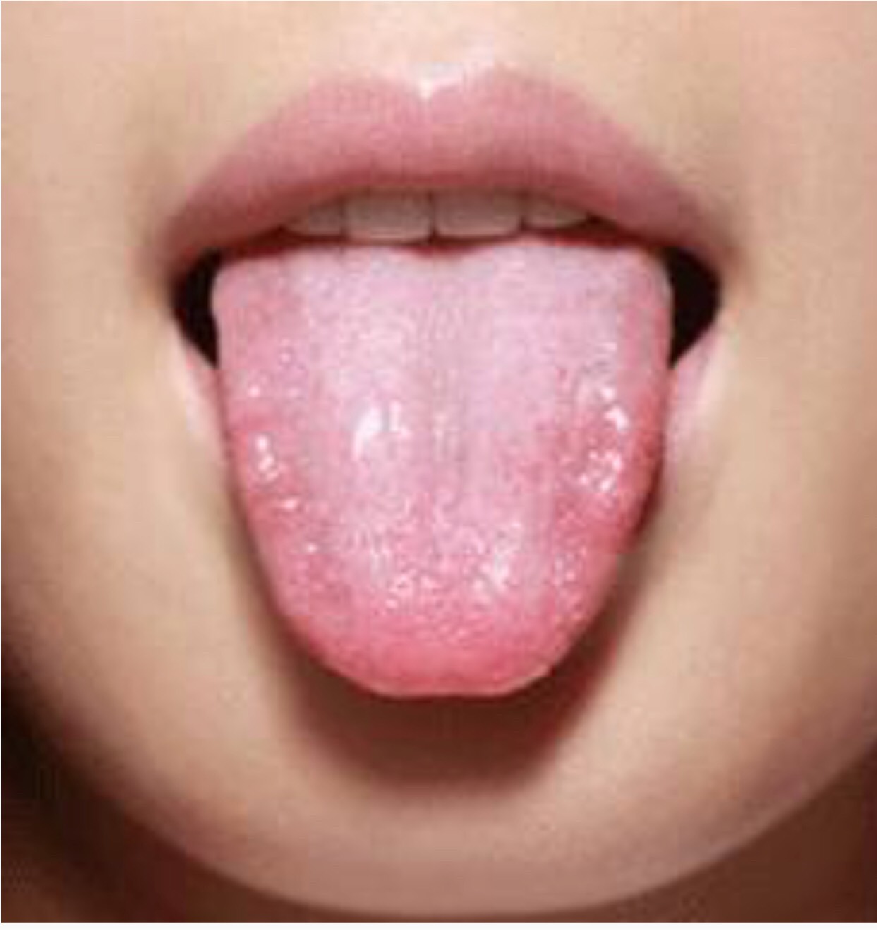 13岁女孩舌苔图片