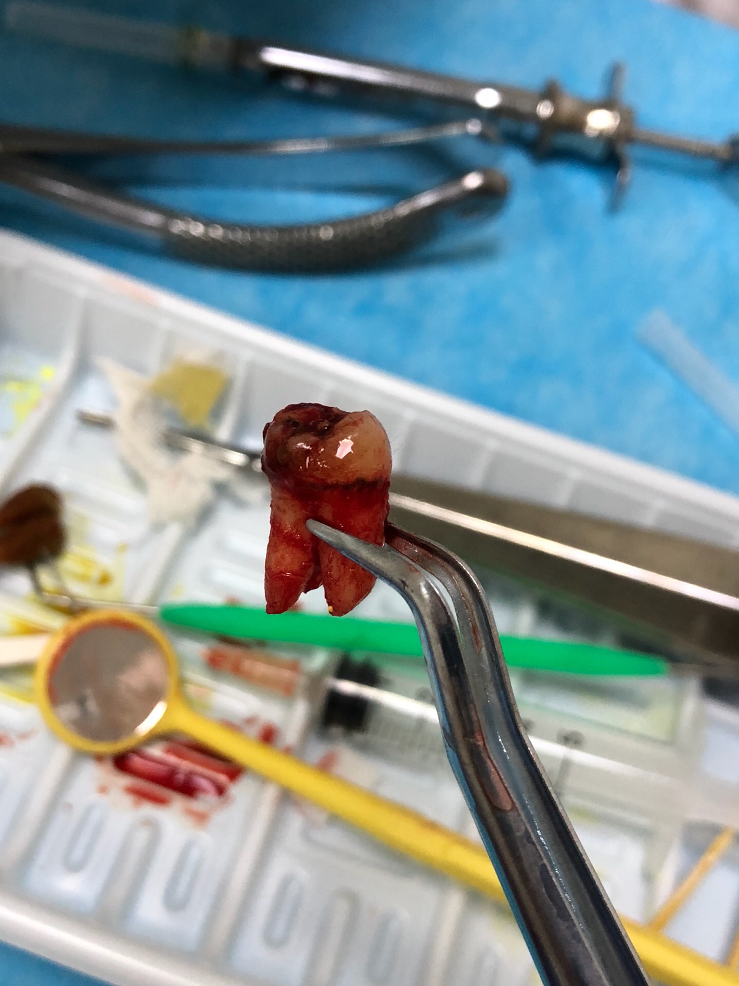 今天拔了颗立事牙…… 220       赞                   评论